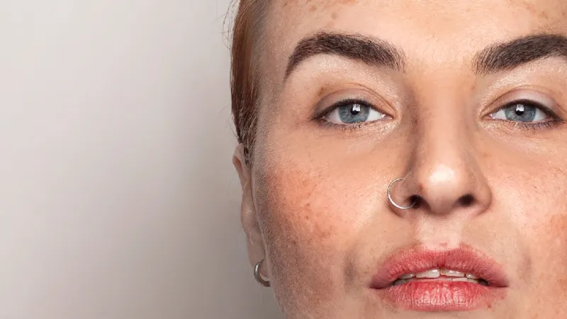 Melasma on face — woman with brown pigmentation spots on cheeks considering injection treatment