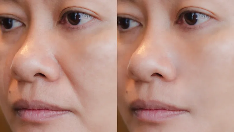 Before-and-after comparison showing improved skin quality and appearance following skin booster treatment.