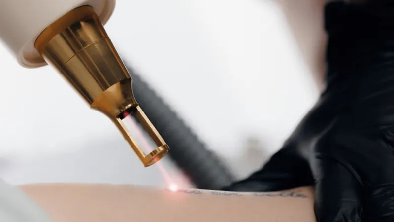 Practitioner using a laser device on a tattooed area of skin.