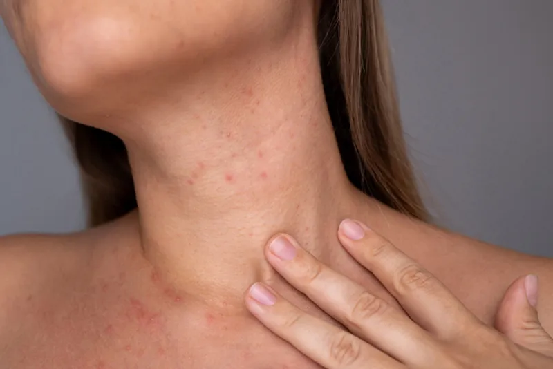 Close-up of a woman’s neck with visible redness and small bumps.