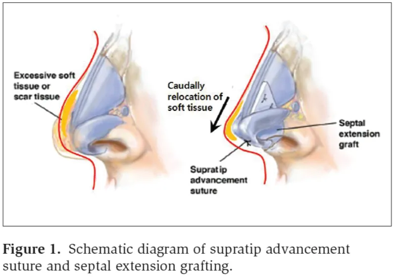 IBON Plastic Surgery clinical illustration