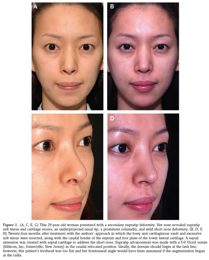 IBON Plastic Surgery clinical illustration