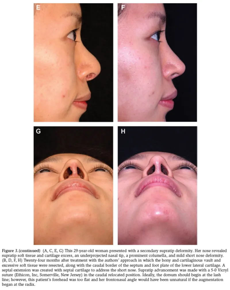 IBON Plastic Surgery clinical illustration
