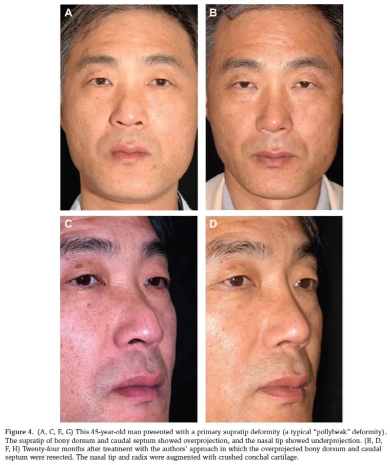 IBON Plastic Surgery clinical illustration