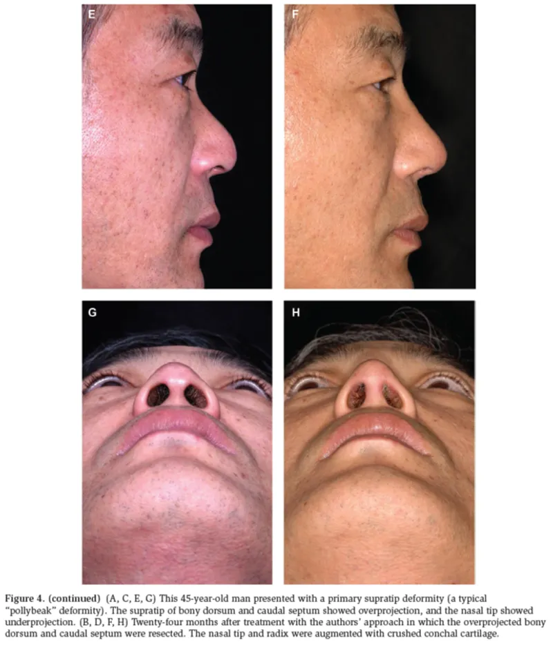 IBON Plastic Surgery clinical illustration