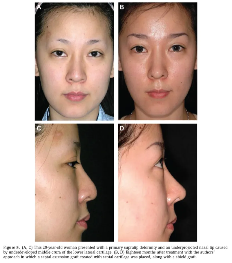 IBON Plastic Surgery clinical illustration