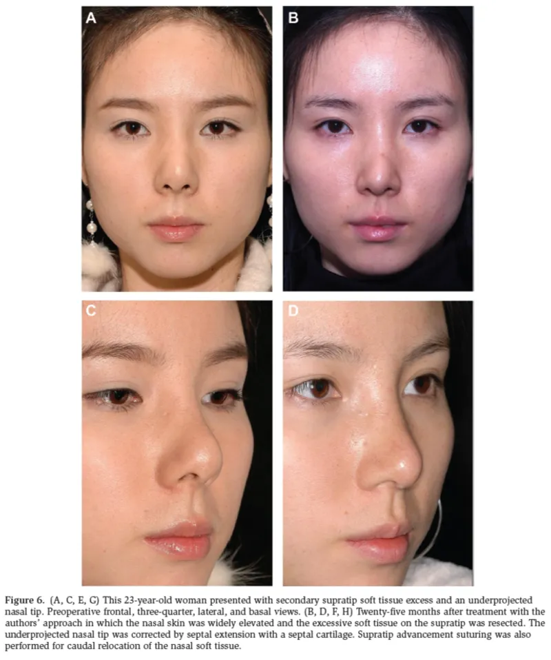 IBON Plastic Surgery clinical illustration