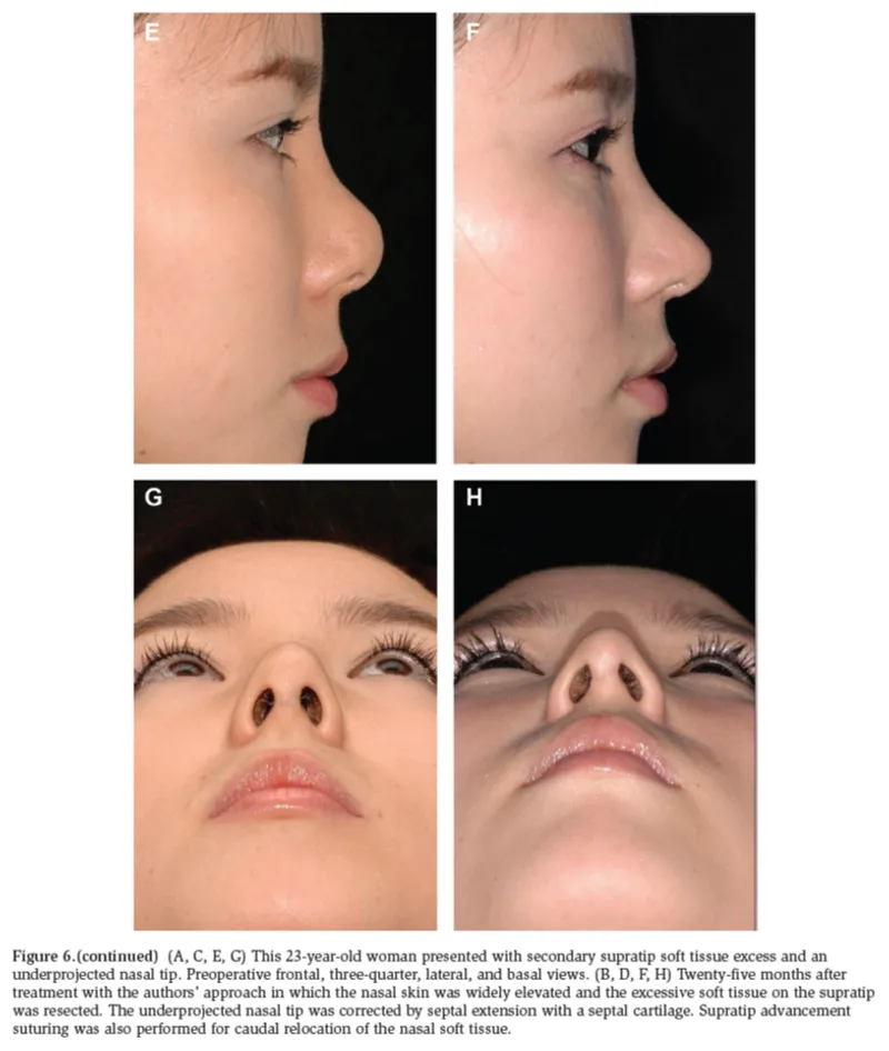 IBON Plastic Surgery clinical illustration