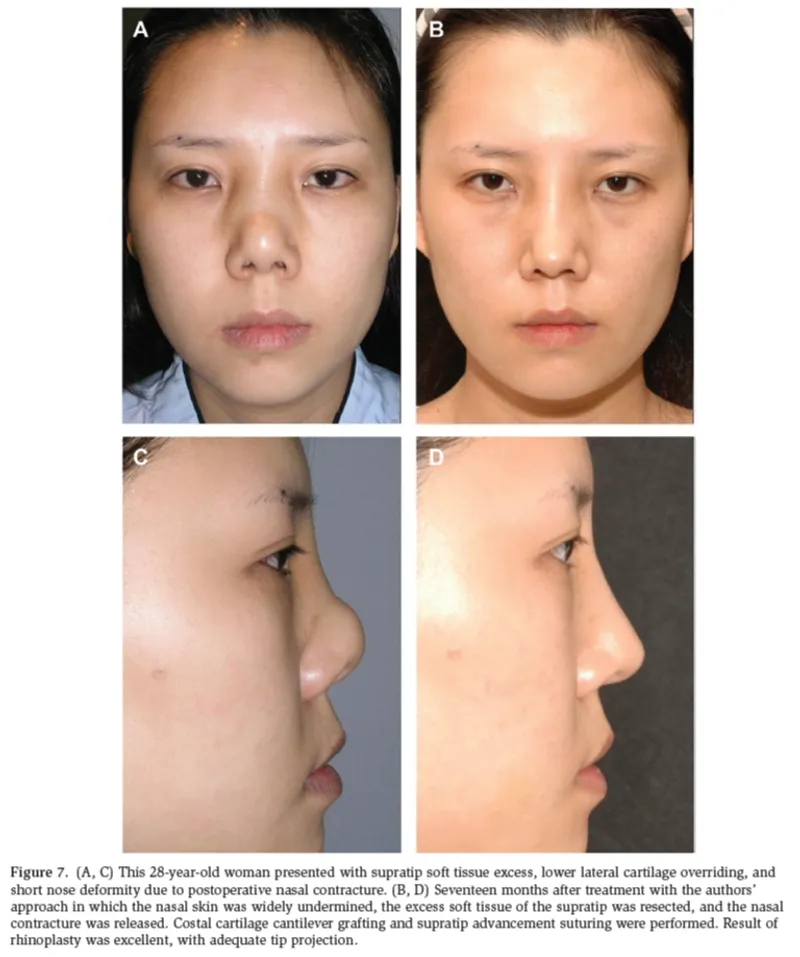 IBON Plastic Surgery clinical illustration