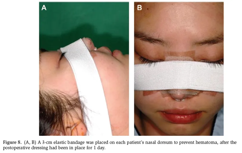IBON Plastic Surgery clinical illustration