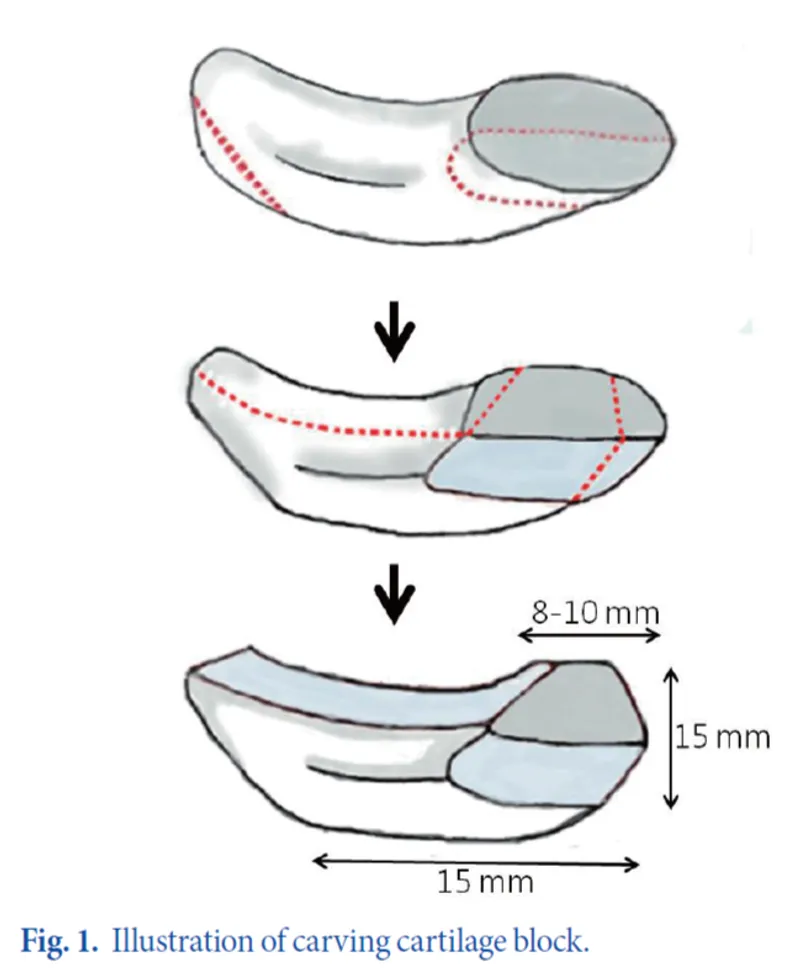 IBON Plastic Surgery clinical illustration