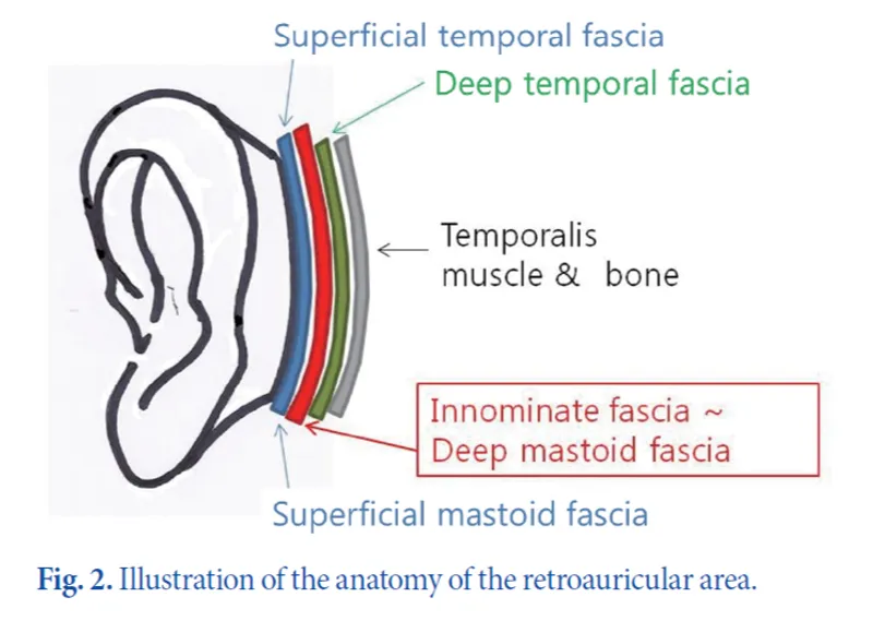 IBON Plastic Surgery clinical illustration