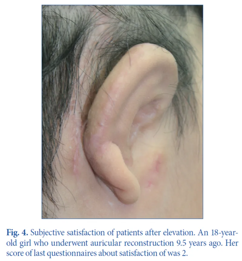 IBON Plastic Surgery clinical illustration