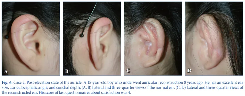 IBON Plastic Surgery clinical illustration