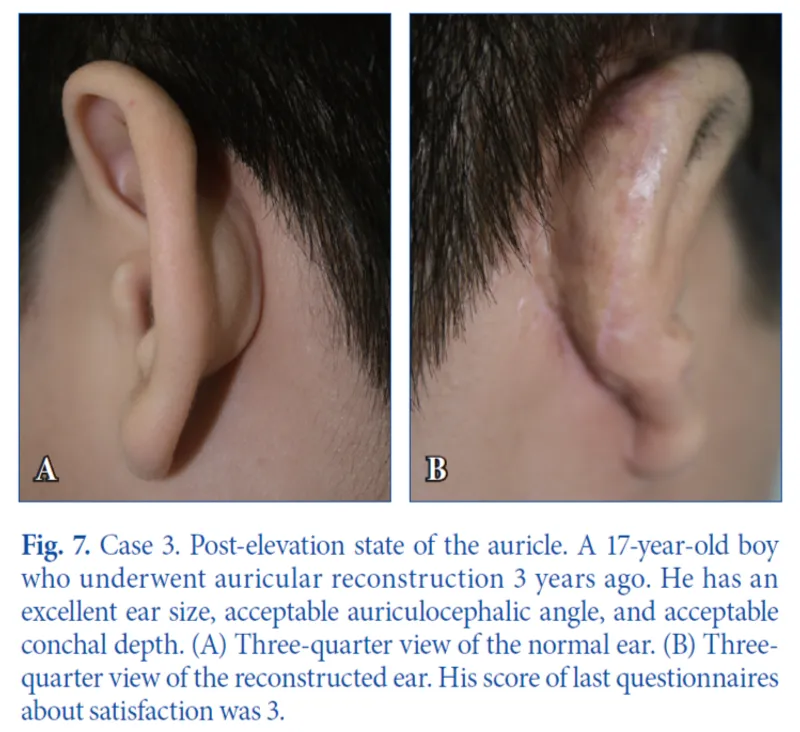 IBON Plastic Surgery clinical illustration