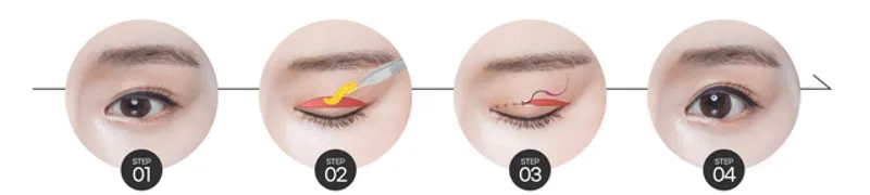 Droopy eyelid correction techniques tailored to individual eyelid conditions and surgical needs.