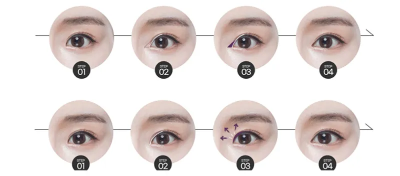 Step-by-step procedure diagram for canthoplasty eye corner surgery options showing surgical design steps 1 through 4