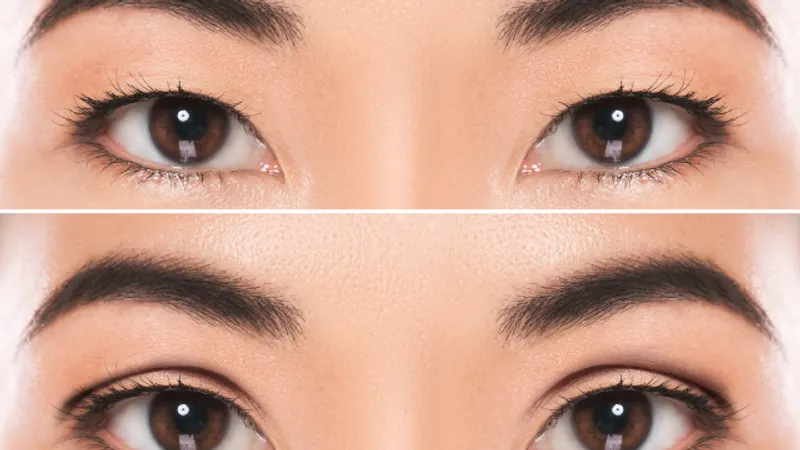 Before-and-after comparison showing changes in eyelid crease and appearance following double eyelid surgery.