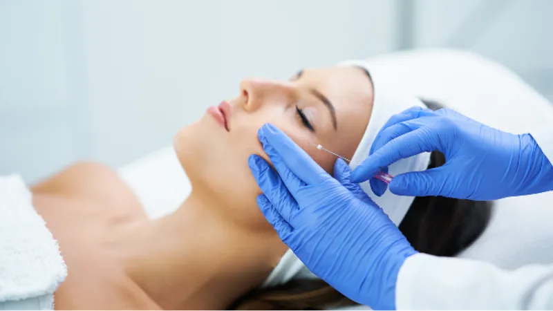 Patient receiving a thread lift treatment on the face.