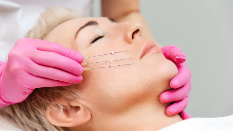 Patient receiving a thread lift treatment.