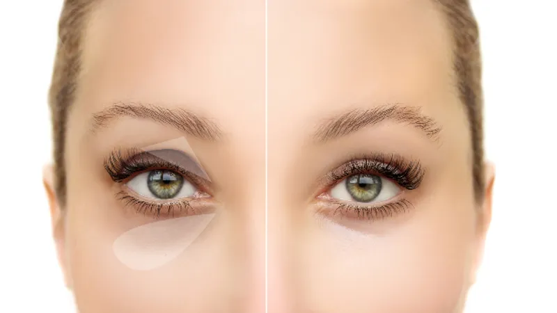 Before-and-after comparison showing changes in eyelid opening and eye appearance following ptosis correction surgery.