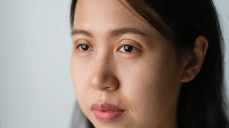 Woman with single eyelids, a common candidate profile for double eyelid surgery