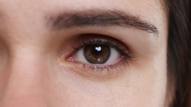 Close-up of an eye and upper eyelid illustrating revision double eyelid surgery and eyelid crease assessment.