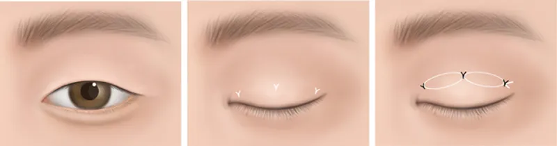 Diagram showing non-incisional double eyelid surgery steps with suture points along the upper eyelid crease