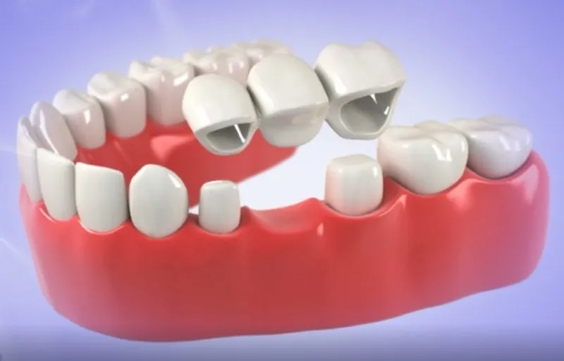 Dental Bridges
