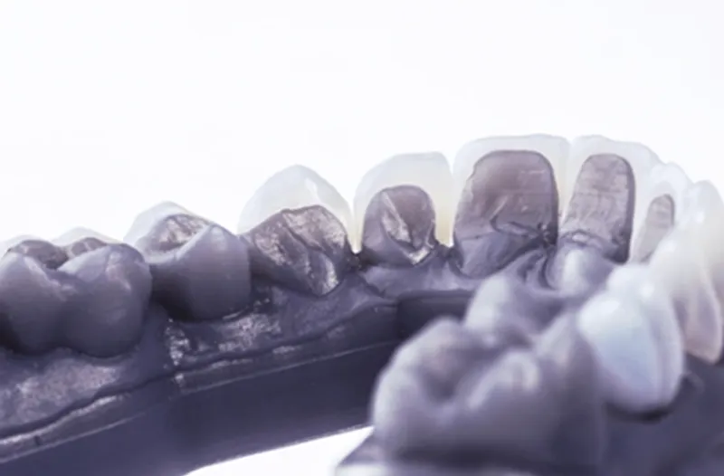 Laminate Veneers