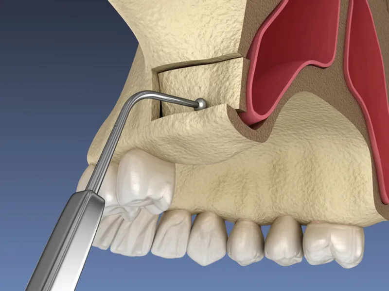 Sinus Lift