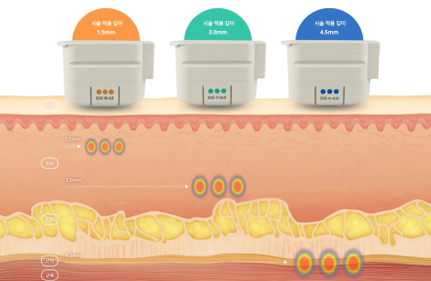 Medical illustration showing treatment depths at 1.5, 3.0, and 4.5 mm.