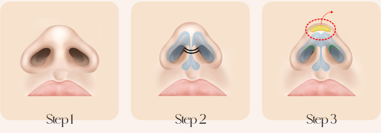 Medical illustration showing the first three steps of nasal surgery.