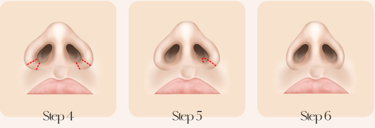 Medical illustration showing the final three steps of nasal surgery.