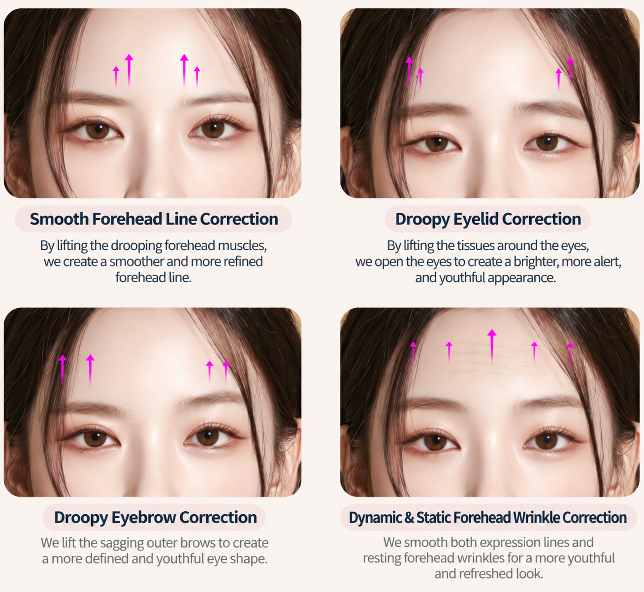Illustration showing forehead, eyelid, eyebrow, and forehead wrinkle correction areas.