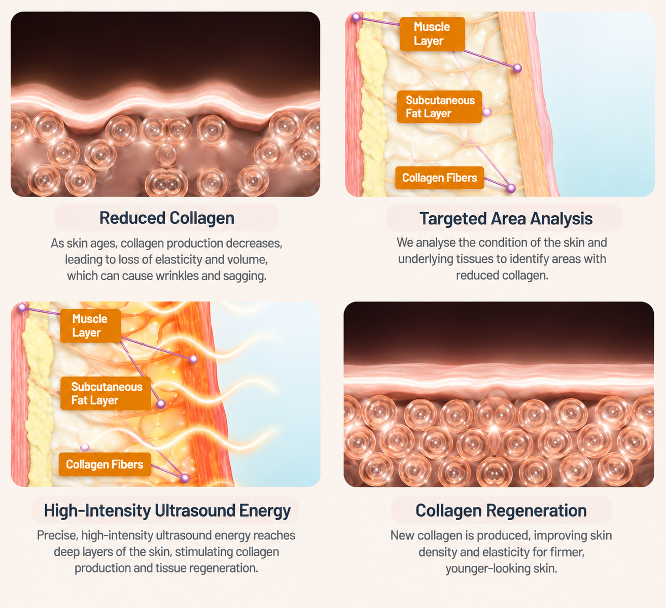 Medical illustration showing reduced collagen, targeted analysis, ultrasound energy, and collagen regeneration.
