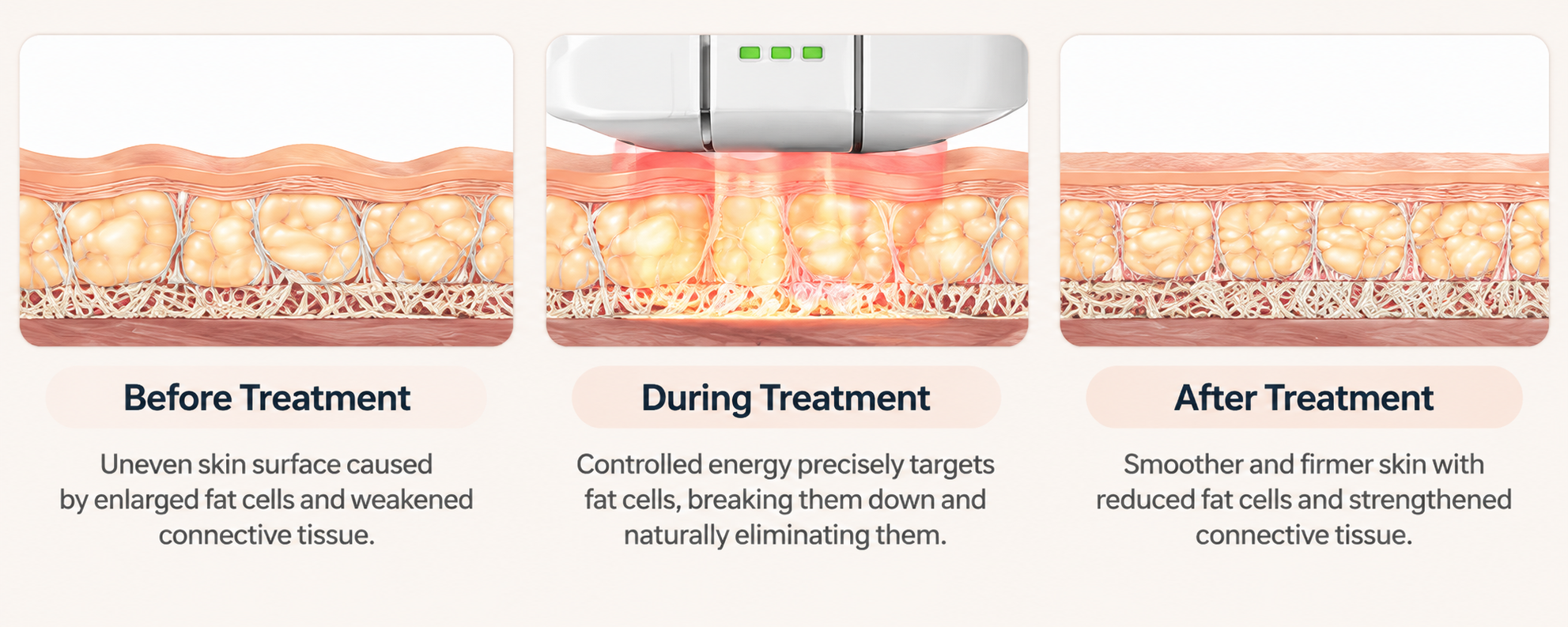 Medical illustration showing skin and fat layers before, during, and after treatment.