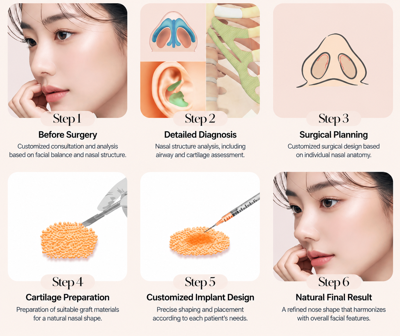Infographic showing consultation, diagnosis, surgical planning, cartilage preparation, implant design, and final result.
