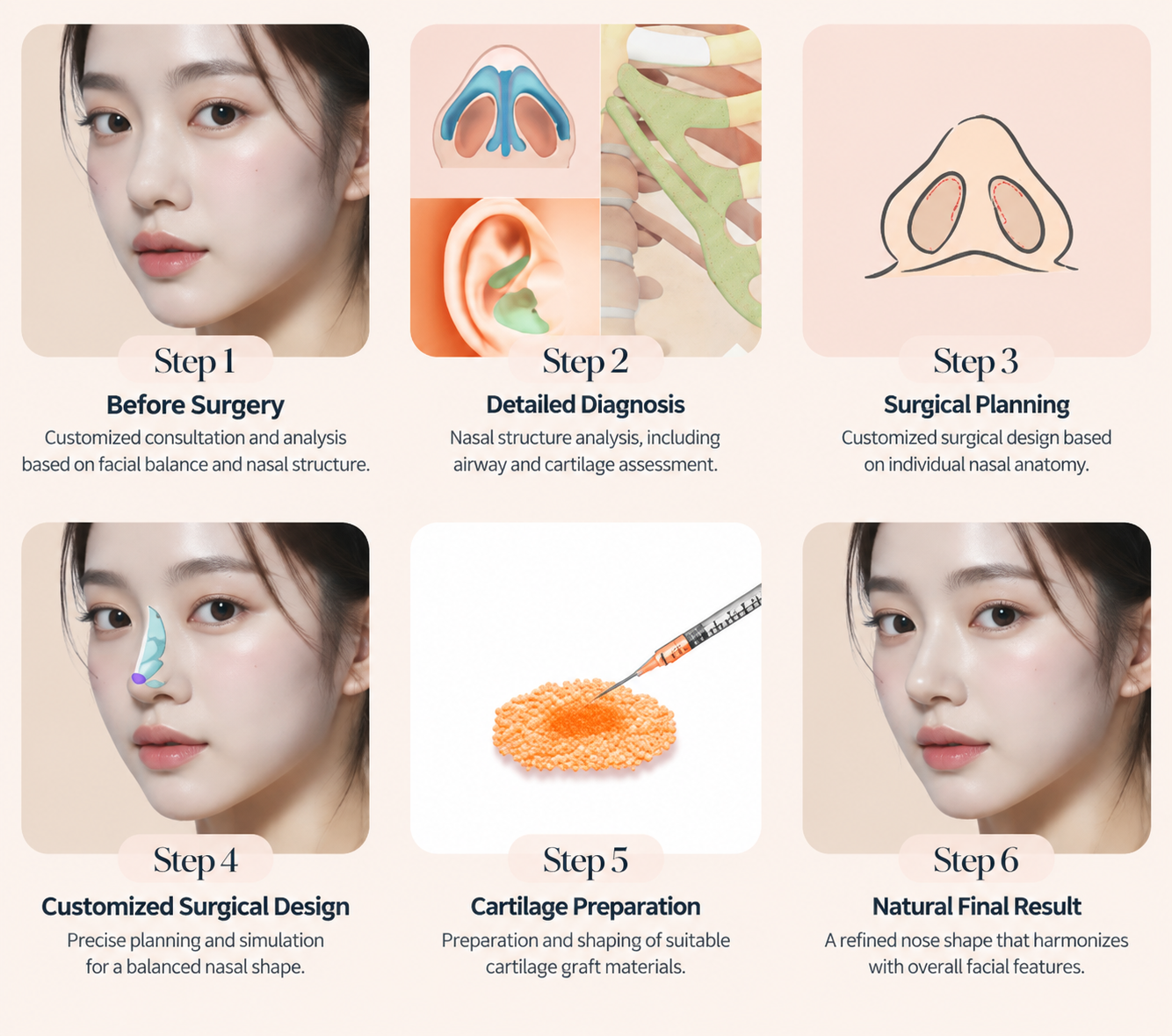 Infographic showing consultation, nasal diagnosis, surgical planning, cartilage preparation, and final result.