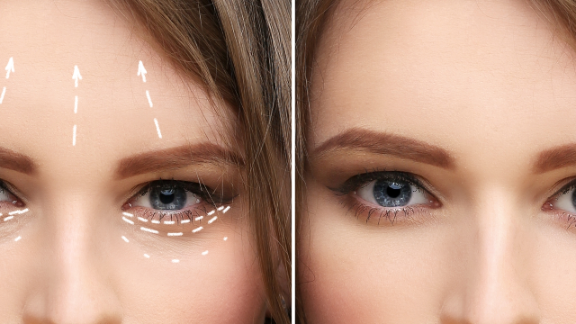 Before-and-after comparison showing forehead and brow changes following forehead lift surgery.