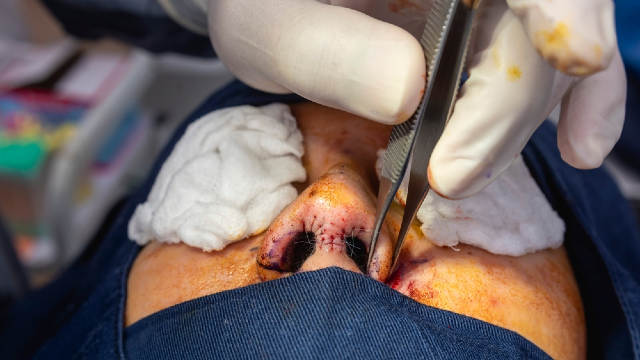Incisional alar reduction surgery — intraoperative close-up of surgical forceps at the nostril base during nostril narrowing procedure
