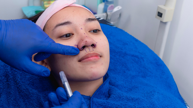 Woman receiving nose markings for alar reduction surgery