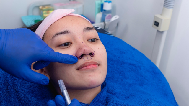 Pre-operative surgical planning and nose markings for functional and aesthetic rhinoplasty