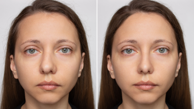 Before-and-after comparison showing changes in nasal shape and appearance following rhinoplasty surgery.