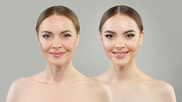 Before-and-after comparison showing facial lifting results and changes in skin appearance following non-surgical lifting treatment.