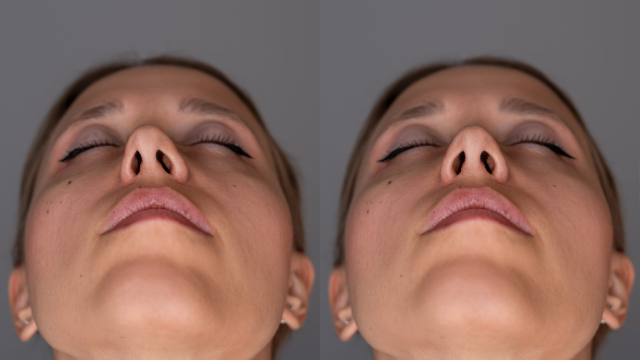 Before and after images showing nostril retraction correction results