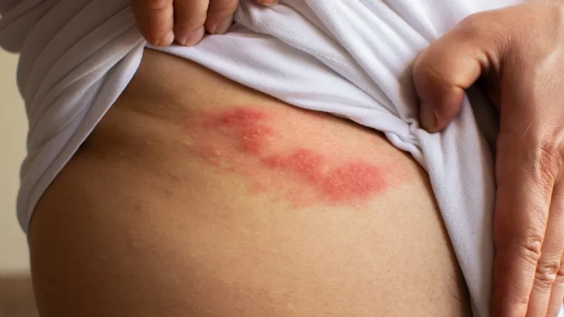 Shingles rash with characteristic blisters along the affected area