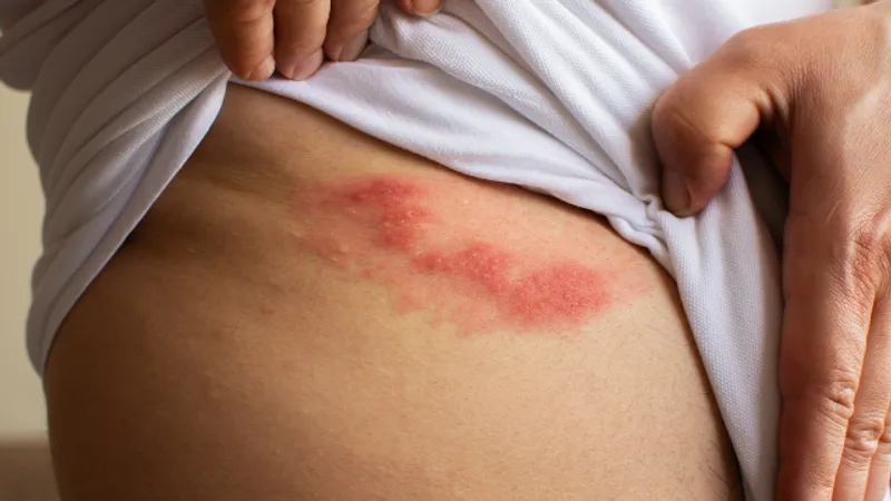 Person with a shingles rash showing red, clustered lesions along the side of the torso.